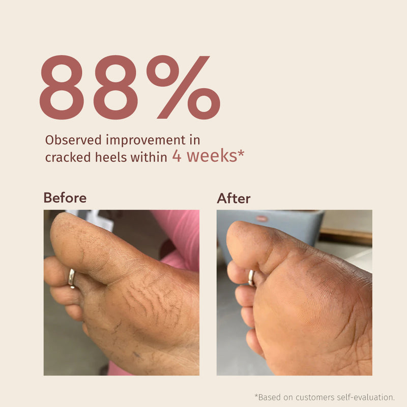 Foot Cream (Treats Cracked Heels) - Vilvah